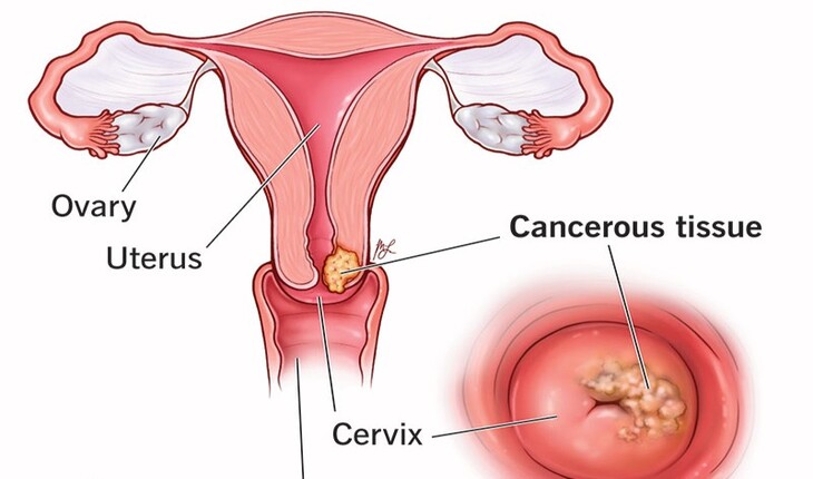 Service Provider of Cervical Cancer Treatment in New Delhi, Delhi, India.