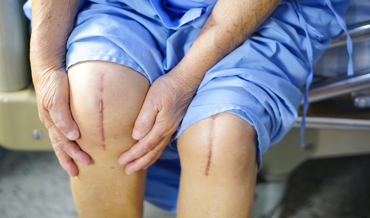 Service Provider of Knee Replacement Surgery in New Delhi, Delhi, India.