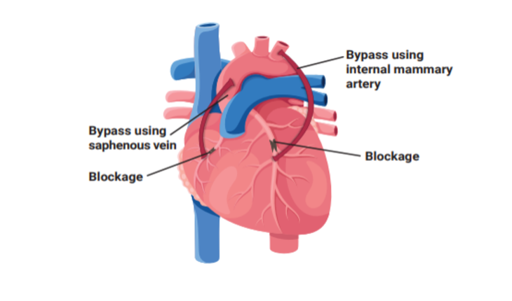 Service Provider of Coronary Artery Bypass Surgery in New Delhi, Delhi, India.