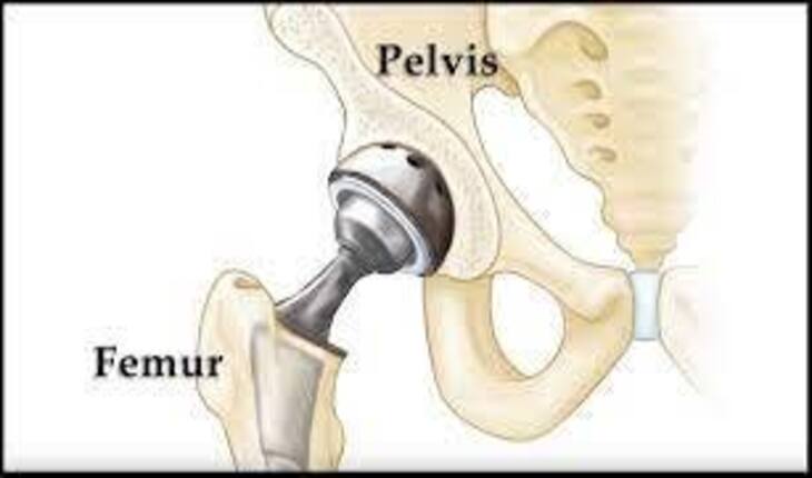 Service Provider of HIP Replacement Surgery in New Delhi, Delhi, India.