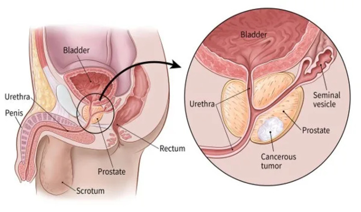 Service Provider of Prostate Cancer Treatment in New Delhi, Delhi, India.