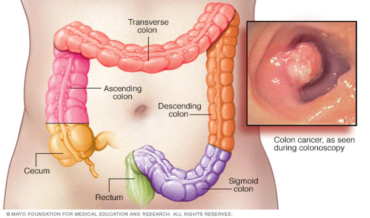 Service Provider of Colon Cancer Treatment in New Delhi, Delhi, India.